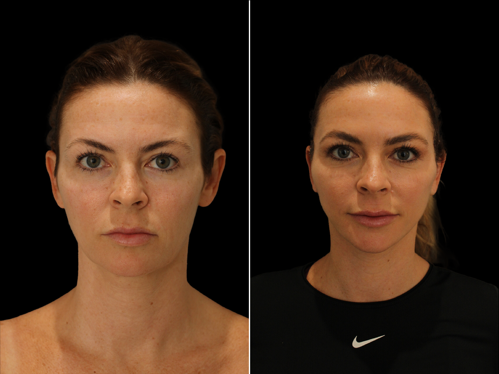 This patient underwent The UpLyft™ facelift combined with a quad blepharoplasty, platysmaplasty, and temporal brow lift.