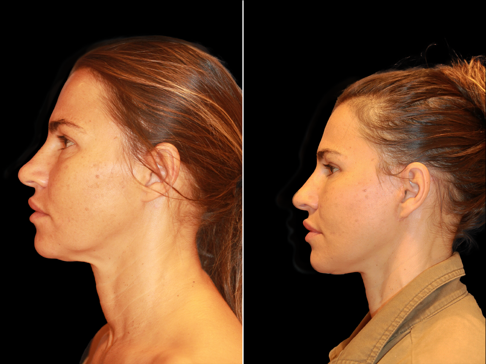 This patient underwent The UpLyft™ facelift combined with a platysmaplasty and temporal brow lift.