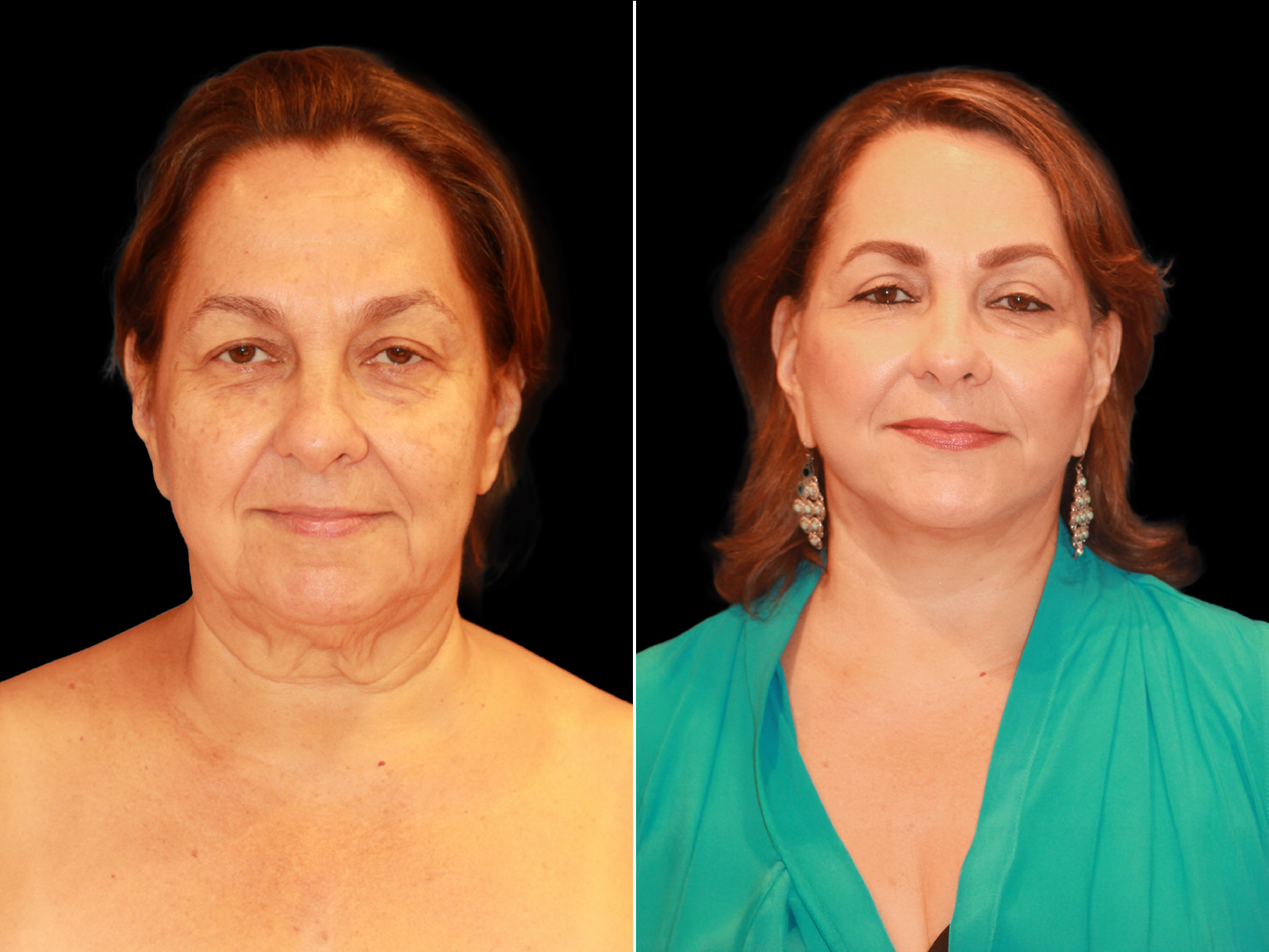 This patient underwent The UpLyft™ facelift combined with a platysmaplasty and a quad blepharoplasty.