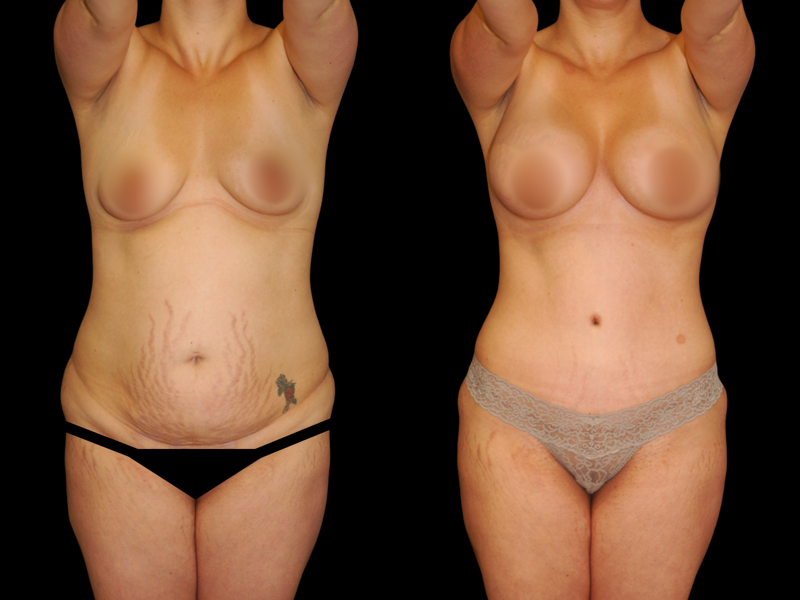 mommy-makeover-before-and-after-dr-soler-baillo-coral-gables-11 (1)