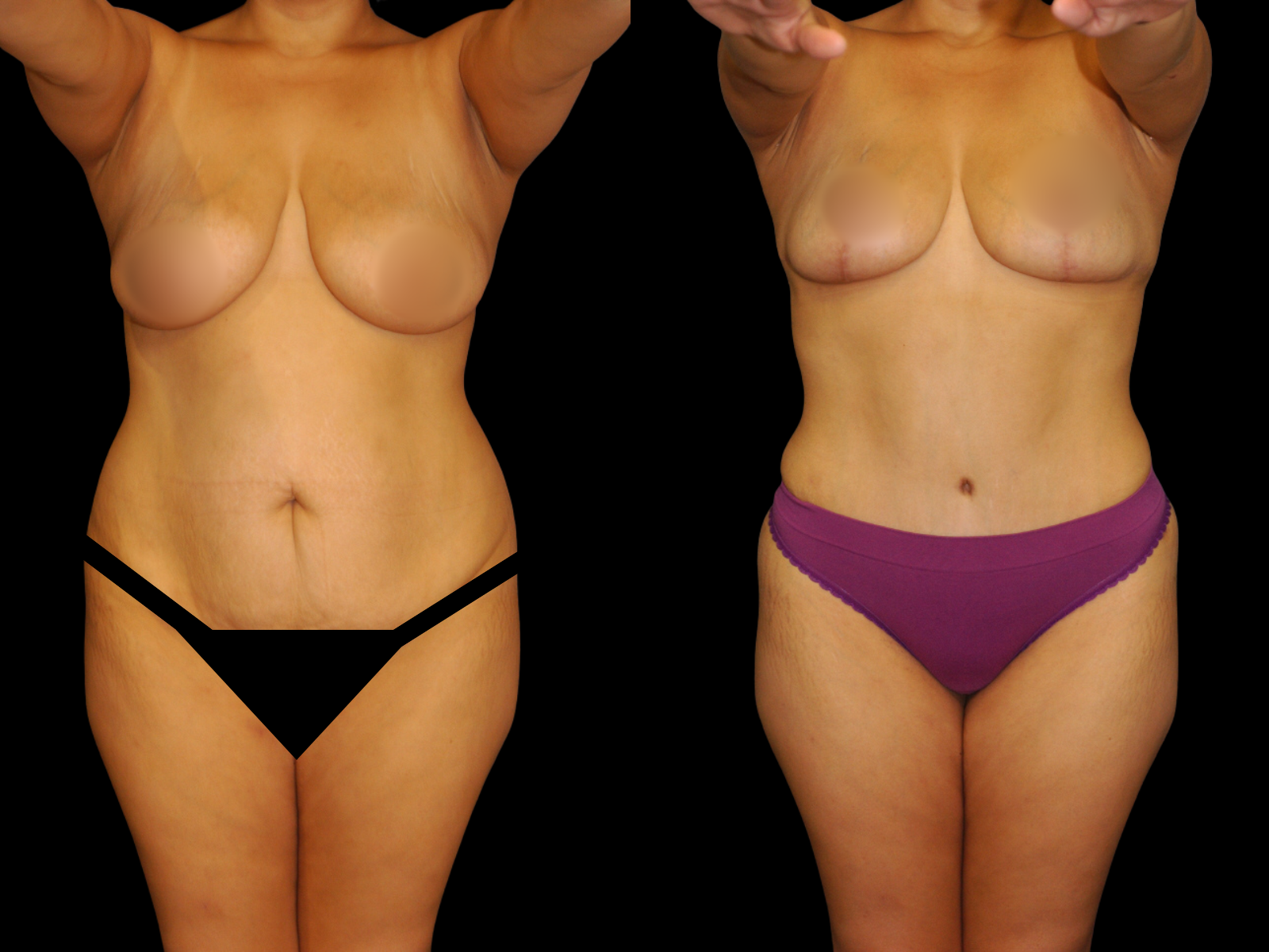 mommy-makeover-before-and-after-dr-soler-baillo-coral-gables-15 (1)
