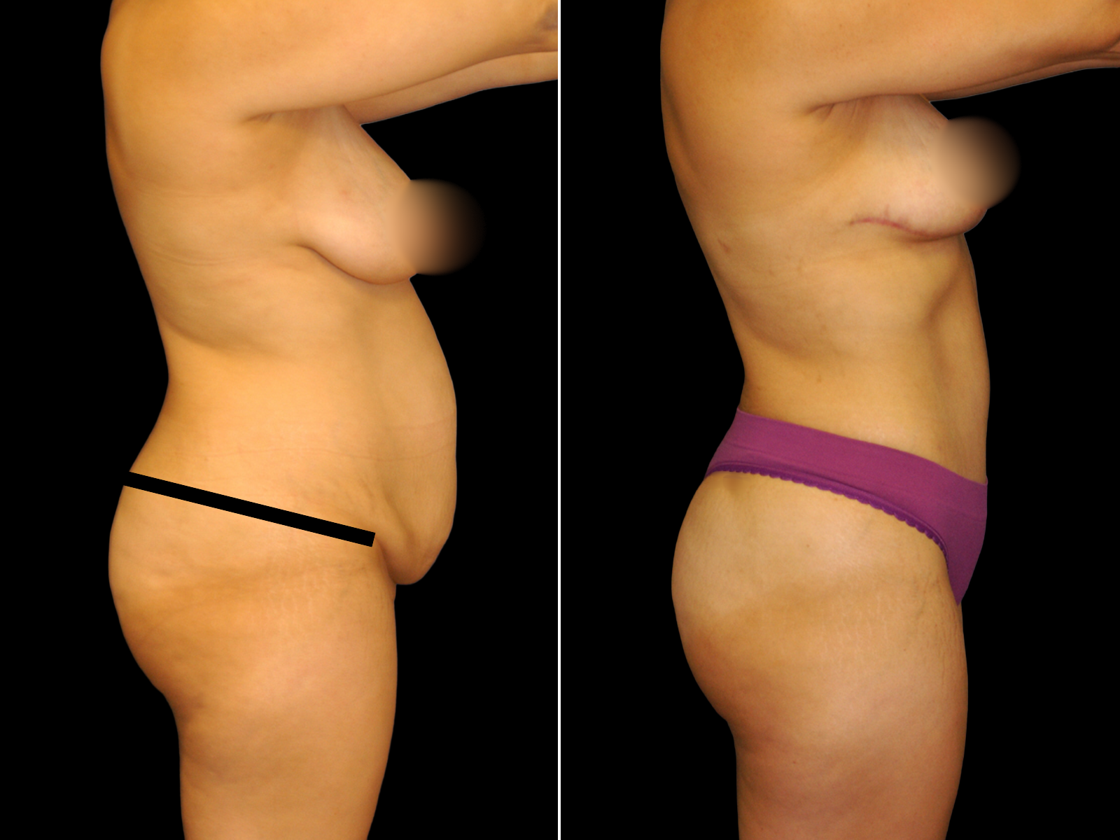 mommy-makeover-before-and-after-dr-soler-baillo-coral-gables-19