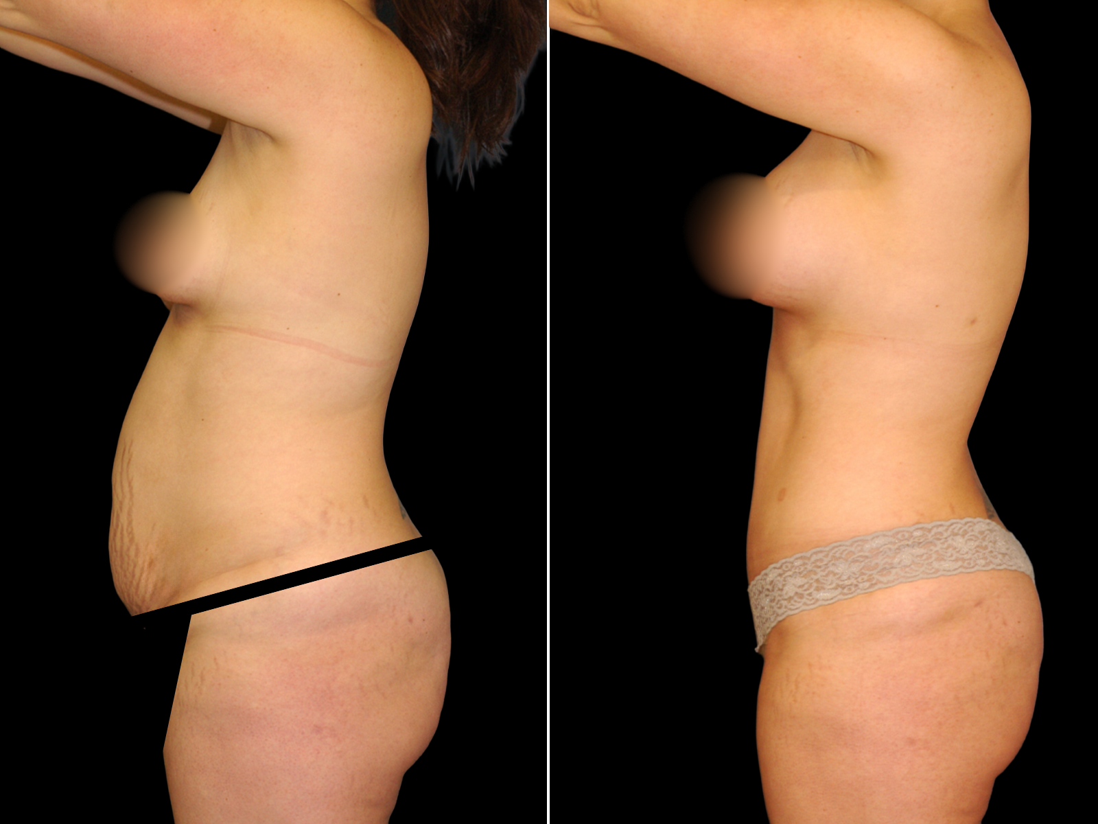 mommy-makeover-before-and-after-dr-soler-baillo-coral-gables-22
