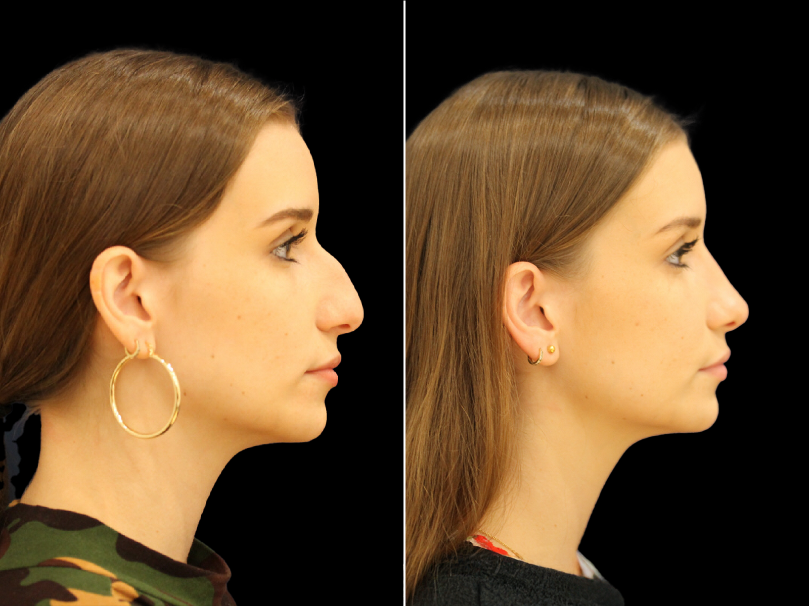 rhinoplasty-before-and-after-dr-soler-baillo-coral-gables-01