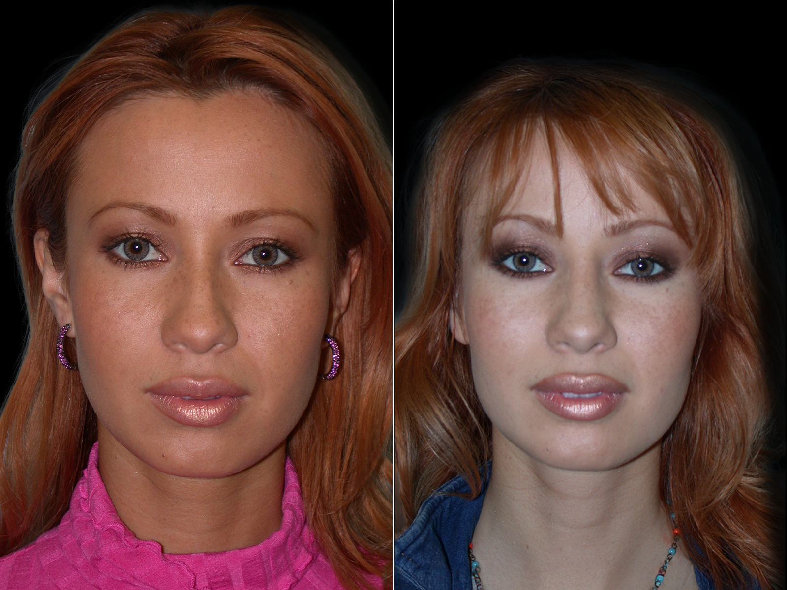 rhinoplasty-before-and-after-dr-soler-baillo-coral-gables-02