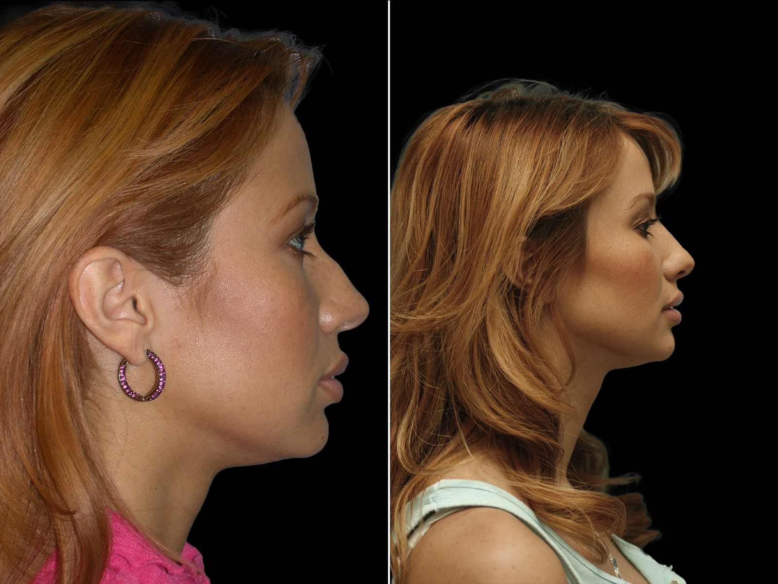 rhinoplasty-before-and-after-dr-soler-baillo-coral-gables-03