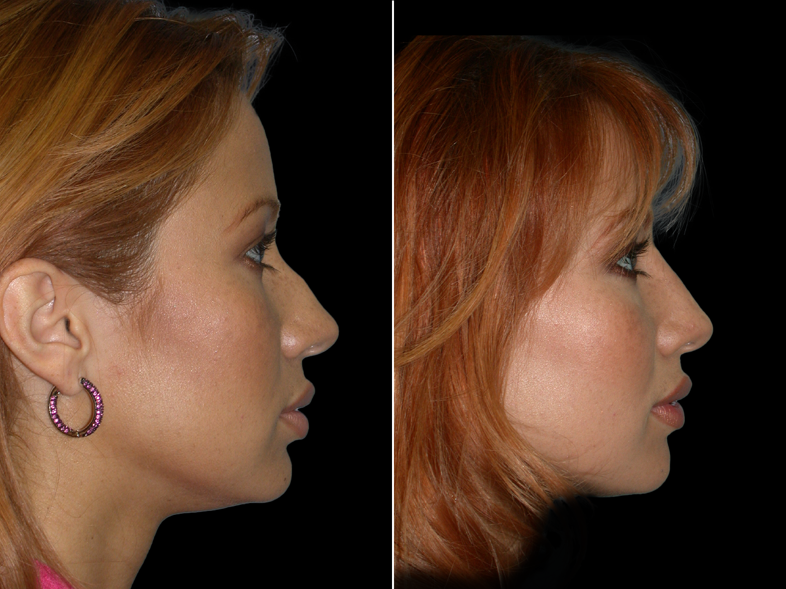 rhinoplasty-before-and-after-dr-soler-baillo-coral-gables-04