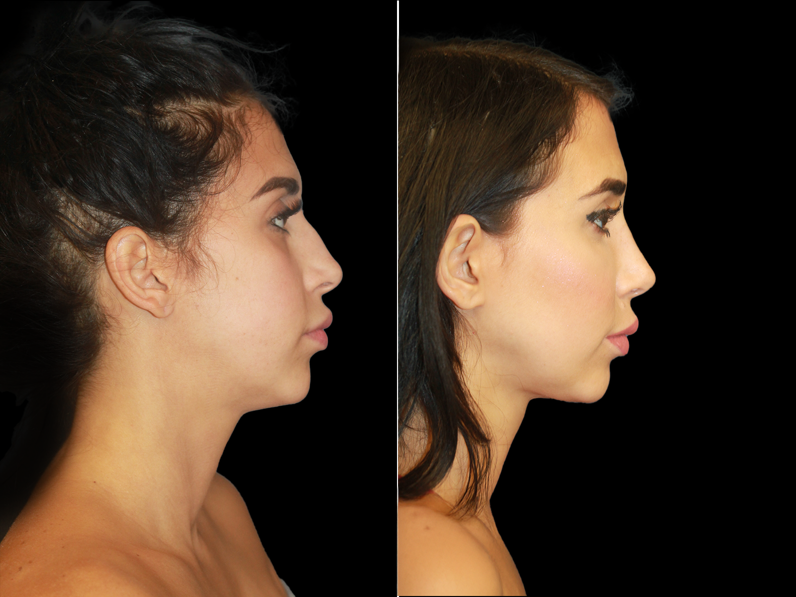 rhinoplasty-before-and-after-dr-soler-baillo-coral-gables-05