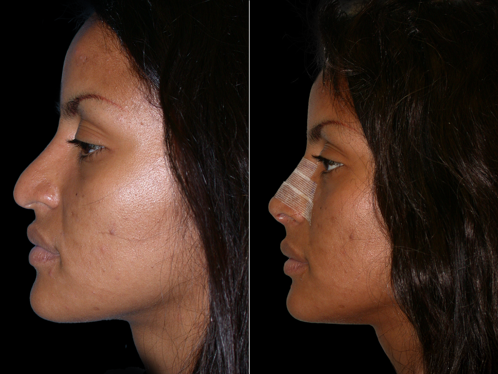 rhinoplasty-before-and-after-dr-soler-baillo-coral-gables-06