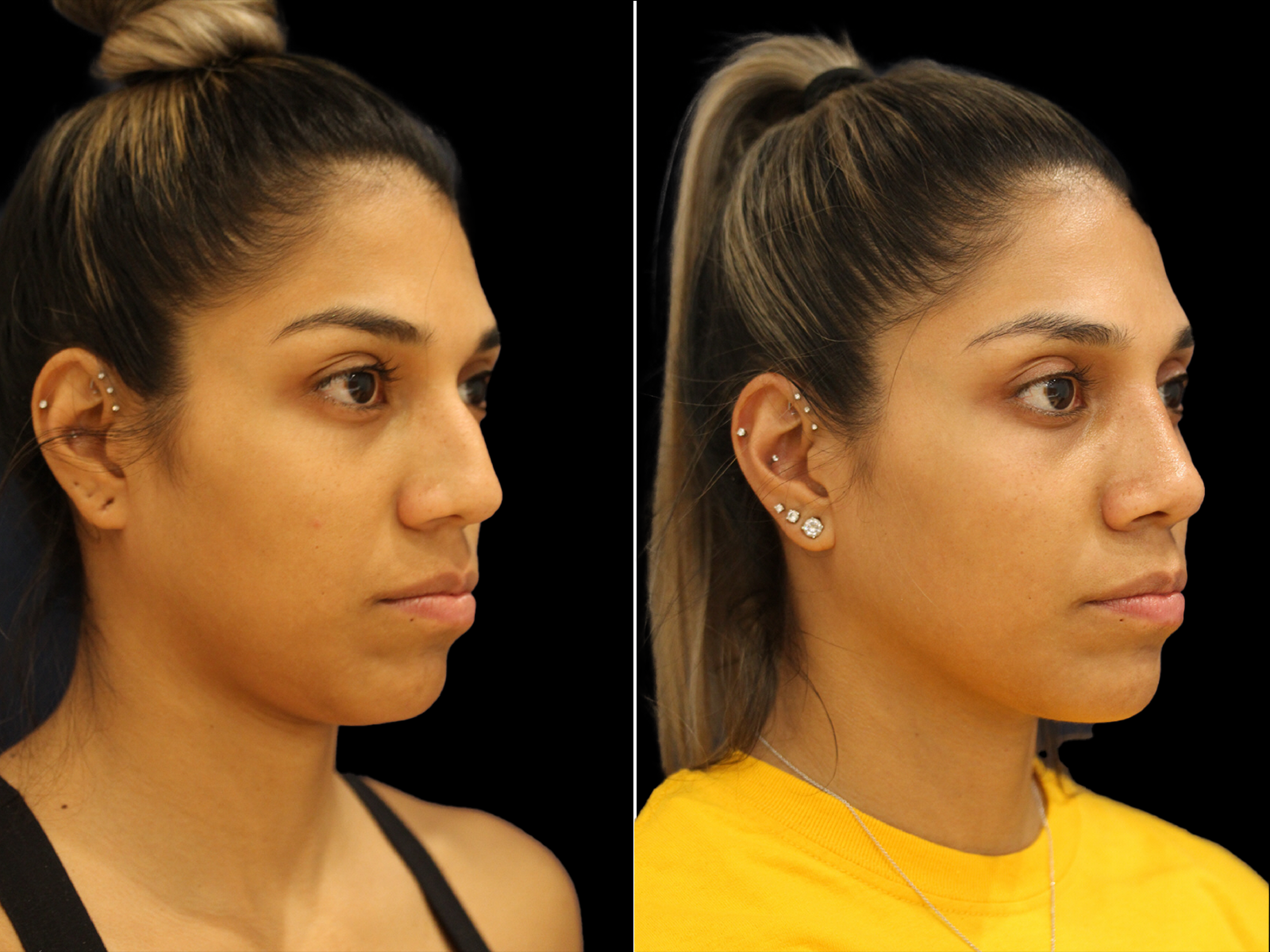 rhinoplasty-before-and-after-dr-soler-baillo-coral-gables-07