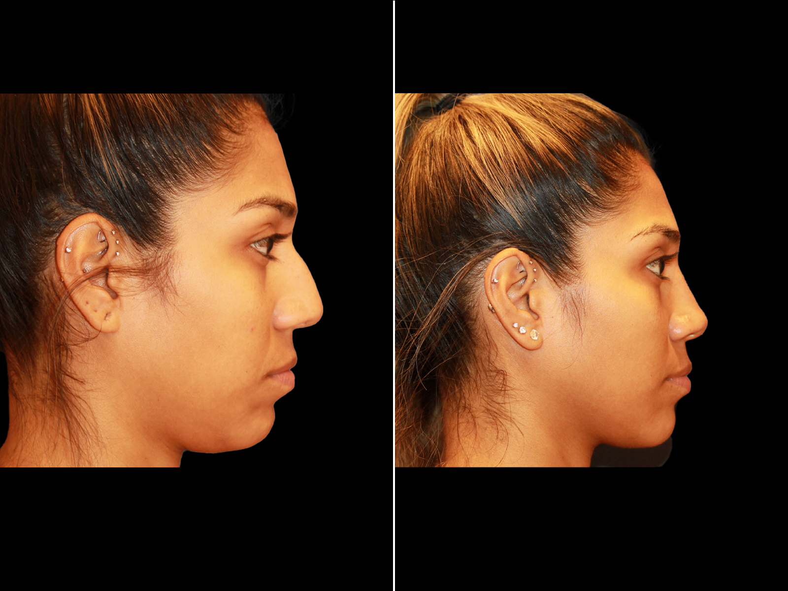 rhinoplasty-before-and-after-dr-soler-baillo-coral-gables-08
