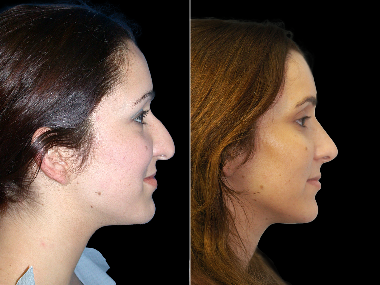 rhinoplasty-before-and-after-dr-soler-baillo-coral-gables-09