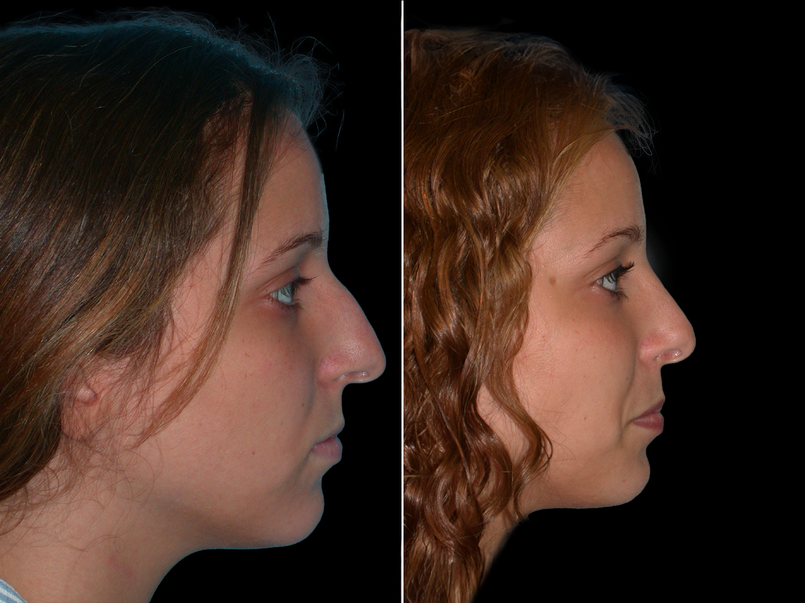rhinoplasty-before-and-after-dr-soler-baillo-coral-gables-10