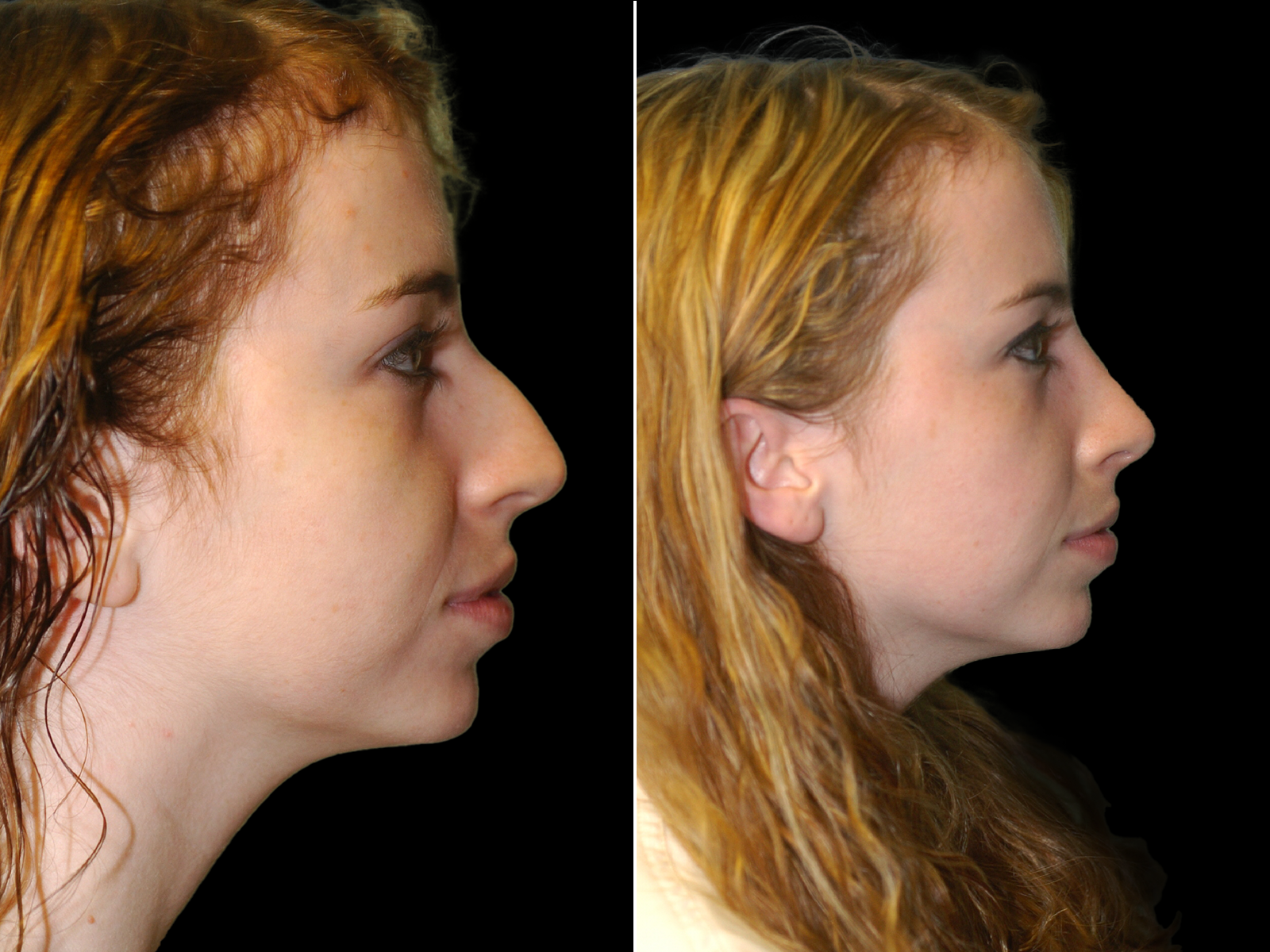 rhinoplasty-before-and-after-dr-soler-baillo-coral-gables-11