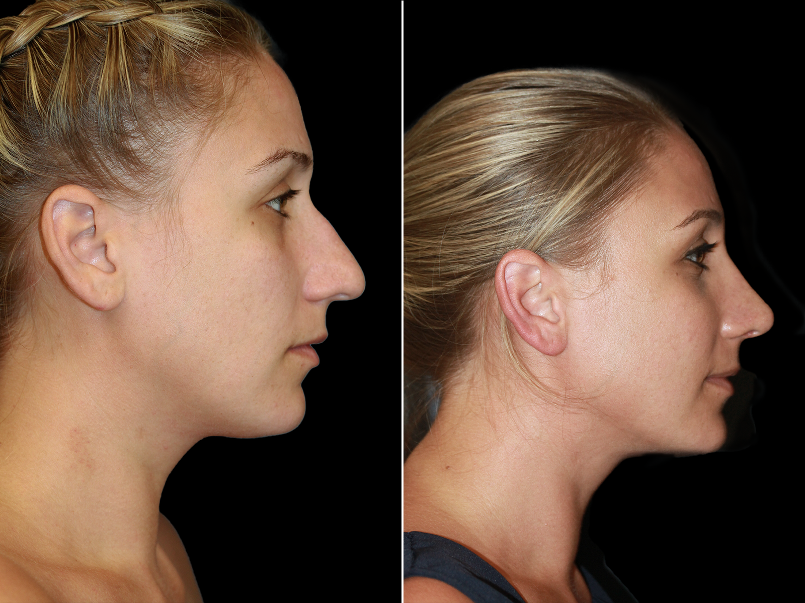 rhinoplasty-before-and-after-dr-soler-baillo-coral-gables-12