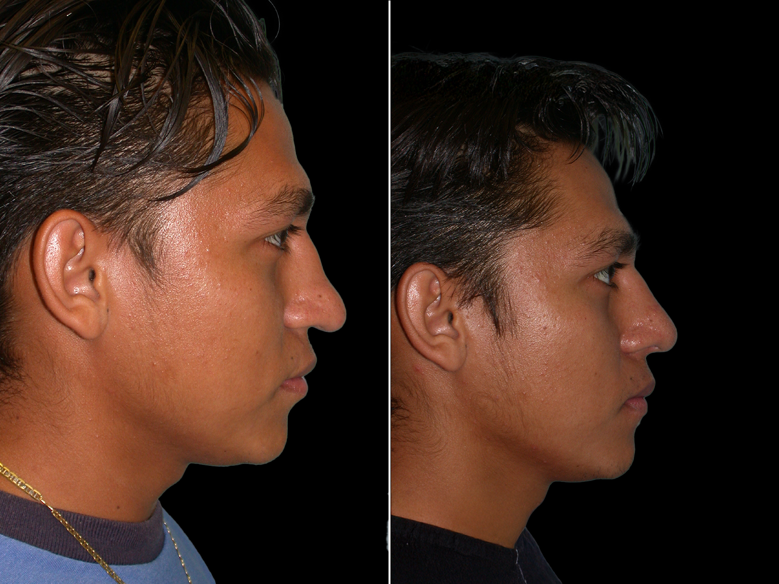 rhinoplasty-before-and-after-dr-soler-baillo-coral-gables-13