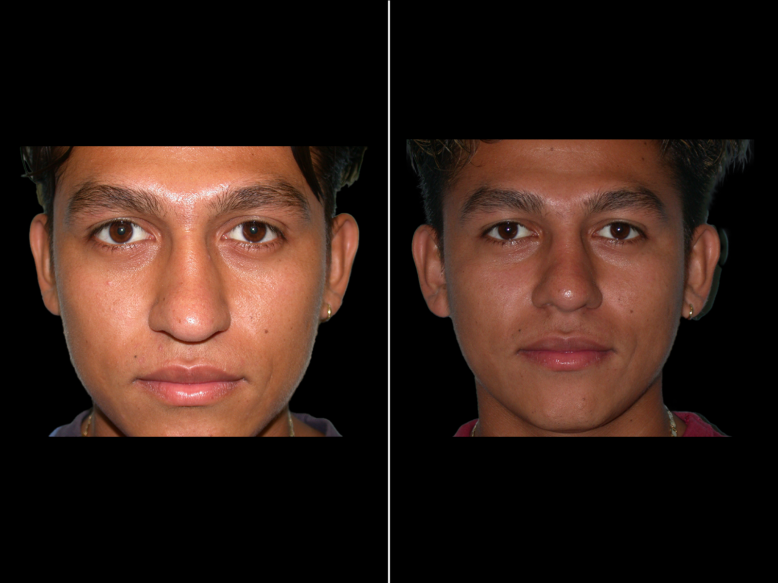 rhinoplasty-before-and-after-dr-soler-baillo-coral-gables-14