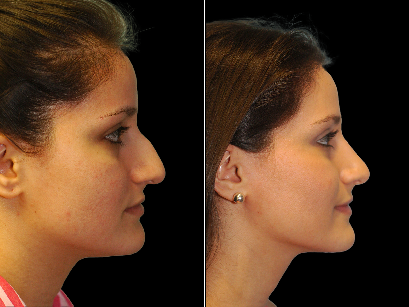 rhinoplasty-before-and-after-dr-soler-baillo-coral-gables-16