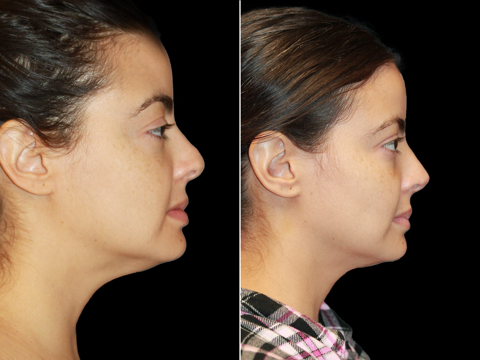 rhinoplasty-before-and-after-dr-soler-baillo-coral-gables-17