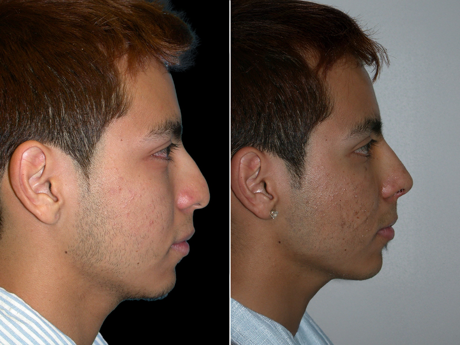 rhinoplasty-before-and-after-dr-soler-baillo-coral-gables-18