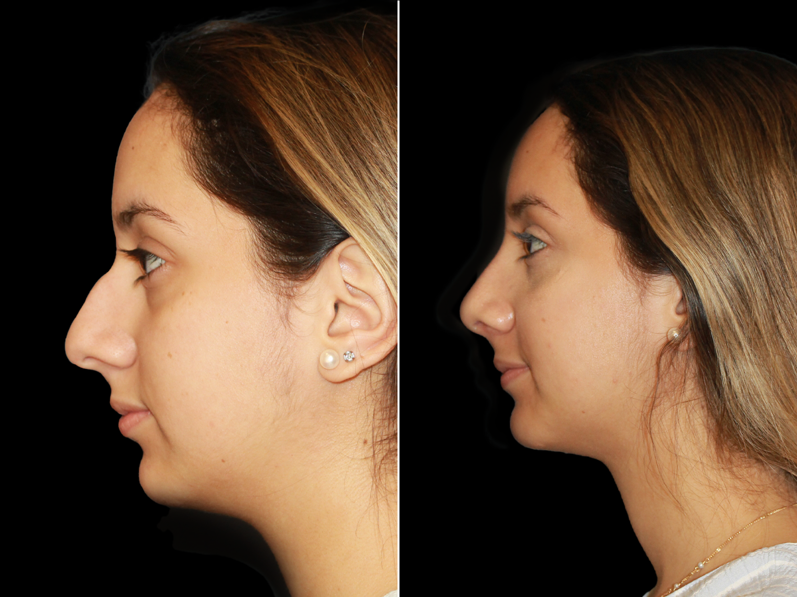 rhinoplasty-before-and-after-dr-soler-baillo-coral-gables-19