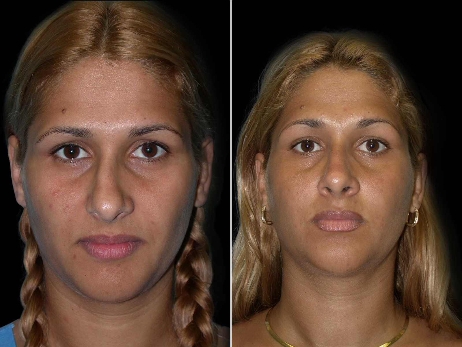 rhinoplasty-before-and-after-dr-soler-baillo-coral-gables-20