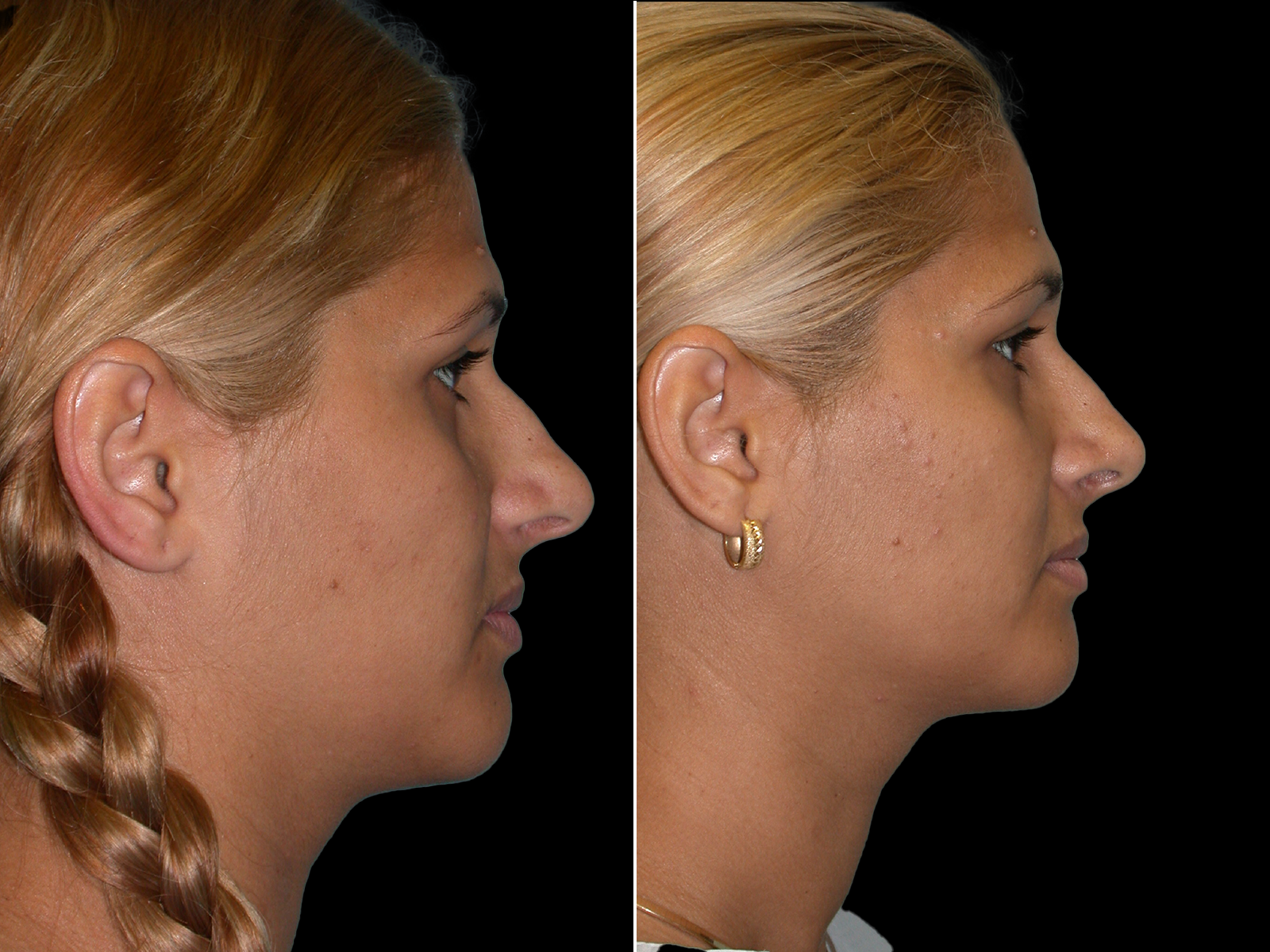 rhinoplasty-before-and-after-dr-soler-baillo-coral-gables-21