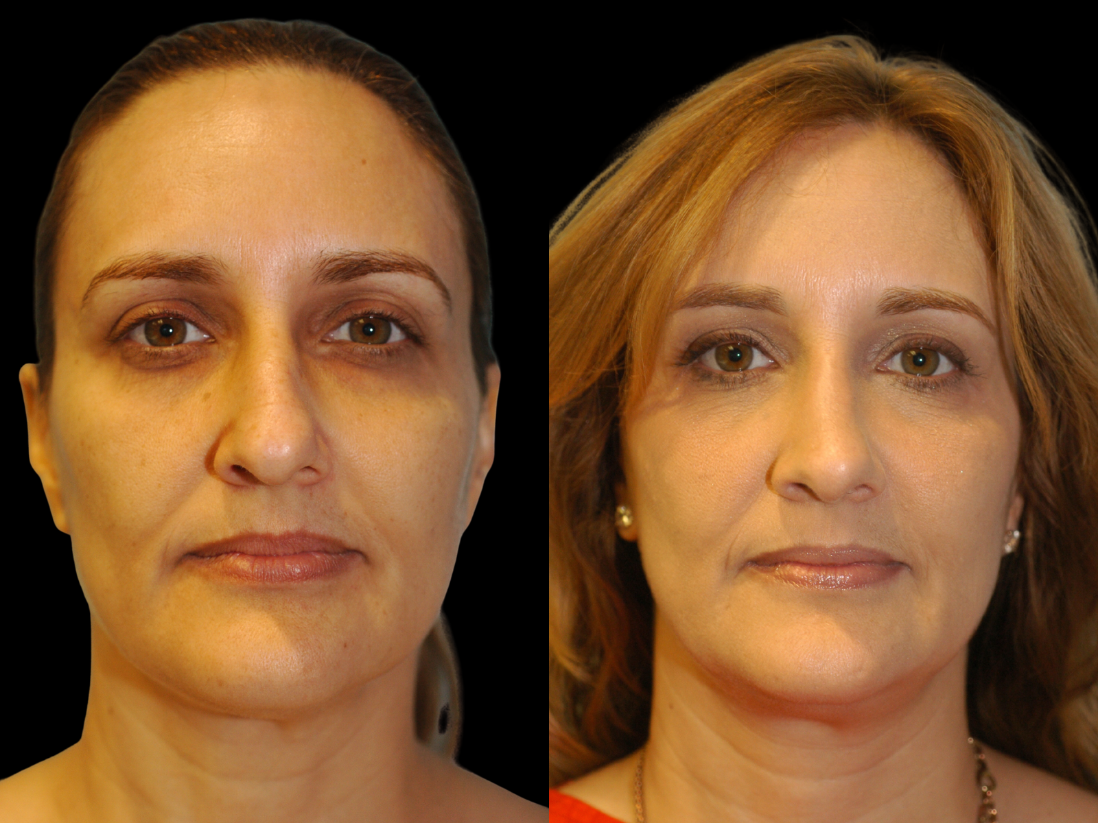 rhinoplasty-before-and-after-coral-gables (1)